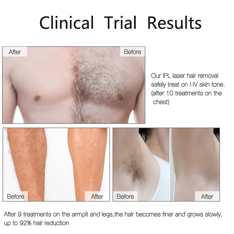 Auriéa Beauty IPL Laser Hair Remover