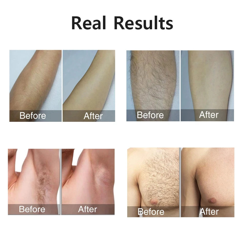 Auriéa Beauty IPL Laser Hair Remover