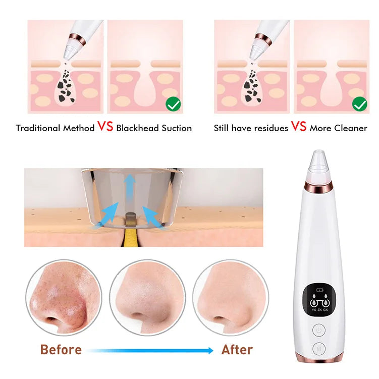 Auriéa Beauty Electric Blackhead Remover