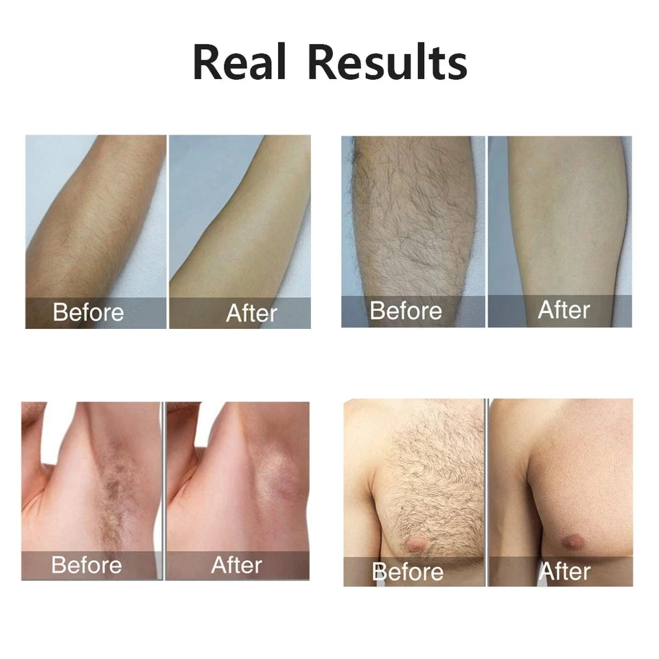 Auriéa Beauty IPL Laser Hair Remover