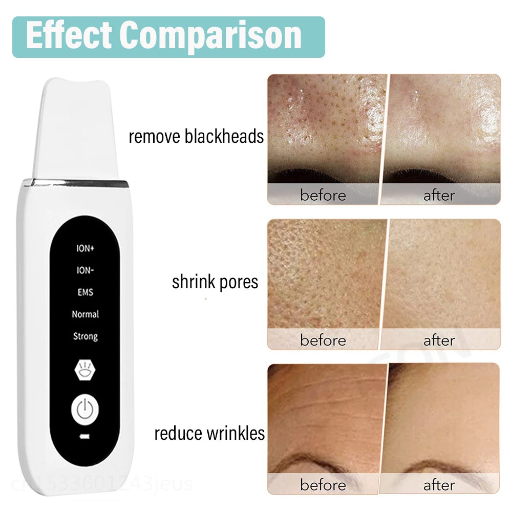 Auriéa Beauty Ultrasonic Skin Scrubber