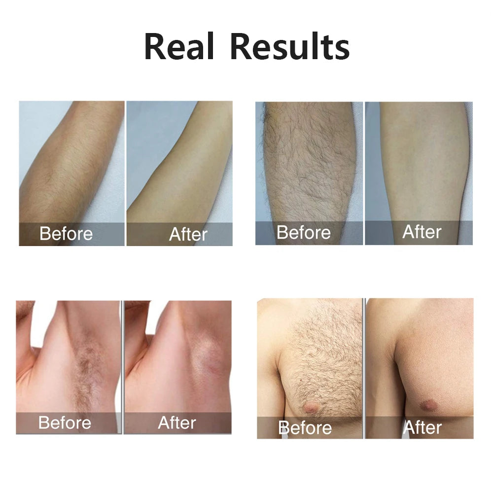 Auriéa Beauty IPL Laser Hair Remover